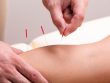 6 benefits of dry needling, dry needling, dry needling for injury prevention