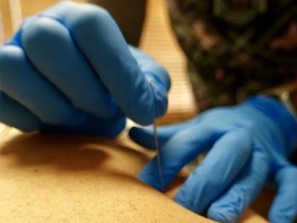 a close up of a therapist conducting dry needling at red rock physical therapy in McHenry IL