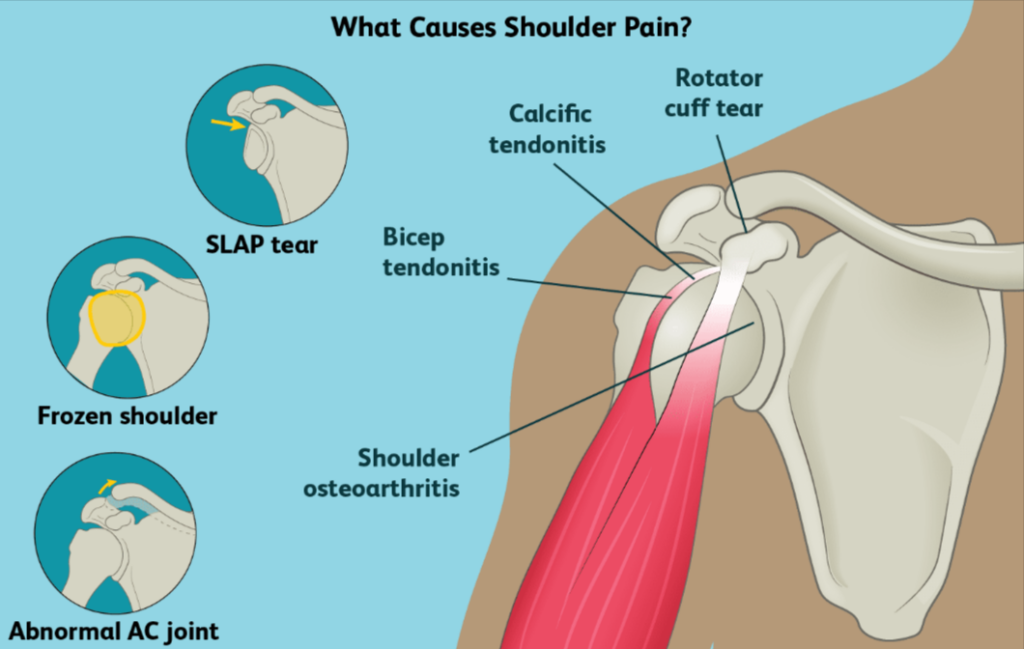 A graphic that illustrates the causes of shoulder pain