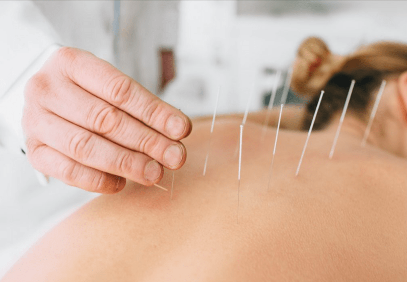 dry needling