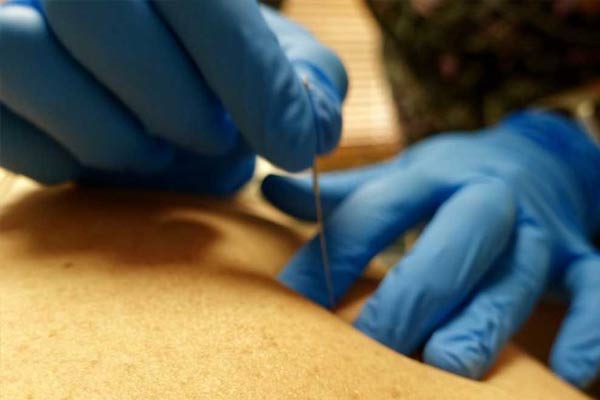 dry-needling-home-m Dry needling