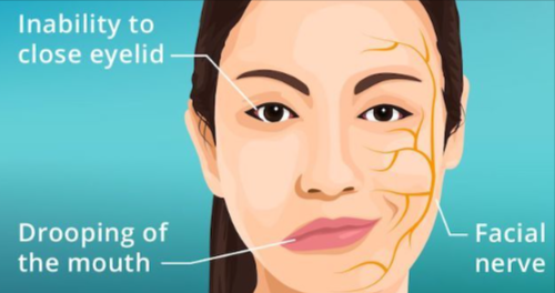 bells palsy symptoms