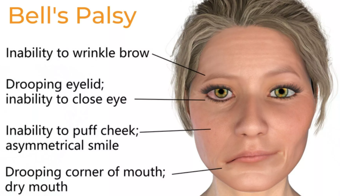 bells palsy causes